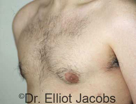 Male breast, after Gynecomastia treatment, l-side oblique view - patient 15