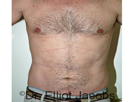 Male body, after Torsoplasty treatment, front view, patient 19