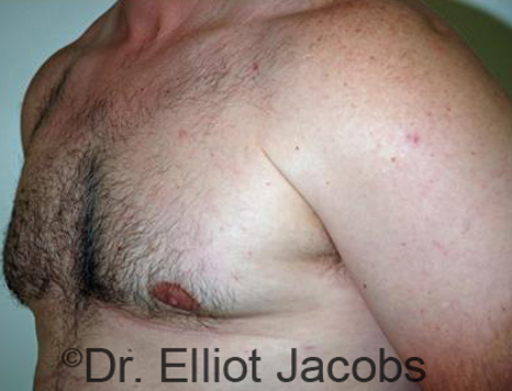 Male body, after Torsoplasty treatment, l-side oblique view, patient 19