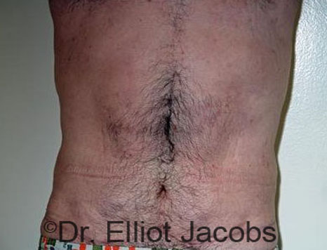 Male body, after Torsoplasty treatment, front view, patient 20