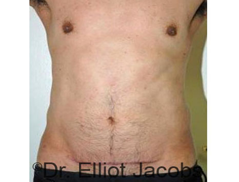 Male body, after Torsoplasty treatment, front view, patient 21