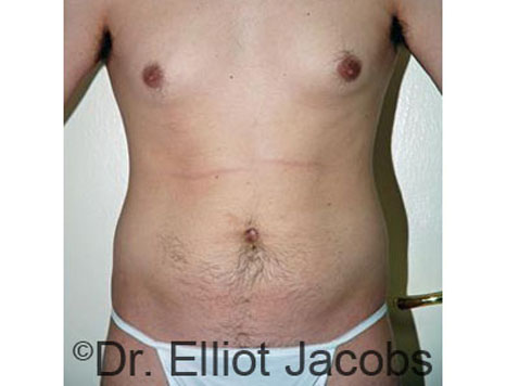Male body, after Torsoplasty treatment, front view, patient 22