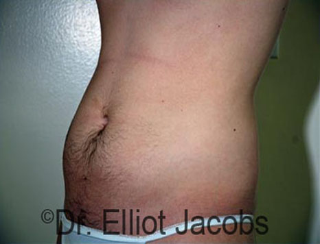 Male body, after Torsoplasty treatment, l-side oblique view, patient 22