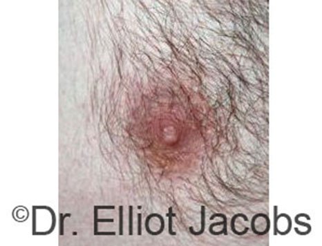 Male nipple, after Peri-Areolar Scars treatment, front view - patient 1