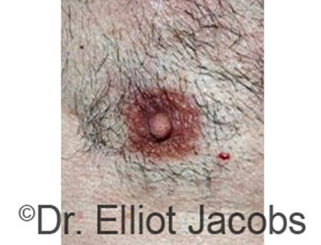 Male nipple, after Peri-Areolar Scars treatment, front view - patient 2