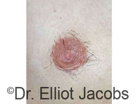 Male nipple, after Peri-Areolar Scars treatment, front view - patient 3