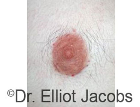 Male nipple, after Peri-Areolar Scars treatment, front view, patient 5