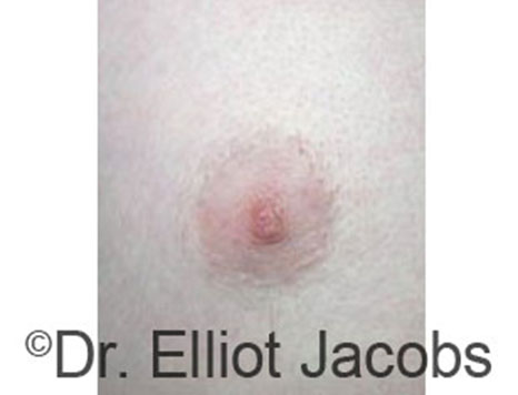 Male nipple, after Peri-Areolar Scars treatment, front view - patient 6