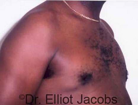 Male breast, after Treatment of Male Chest Asymmetry, oblique view, patient 1