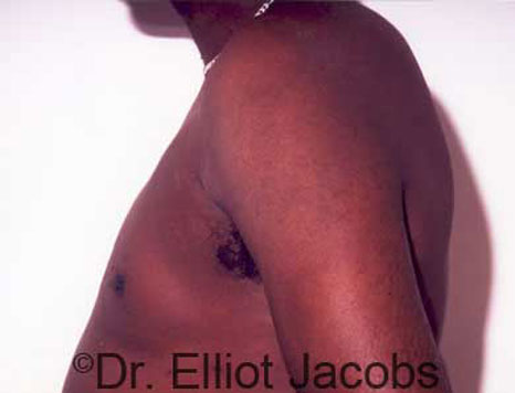Male breast, after Gynecomastia treatment, l-side view - patient 16