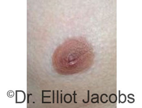 Male nipple, after Peri-Areolar Scars treatment, front view, patient 8