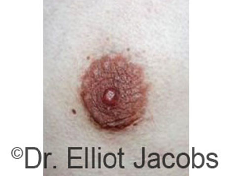 Nipple ring scars discount
