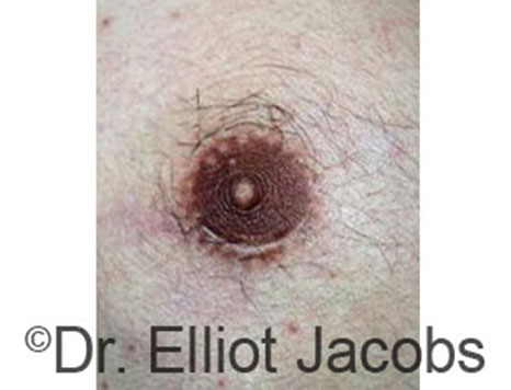 Male nipple, after Peri-Areolar Scars treatment, front view - patient 12