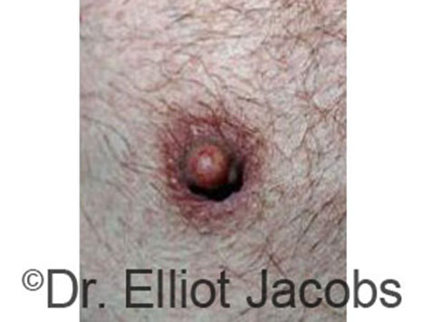 Male nipple, after Peri-Areolar Scars treatment, front view - patient 15