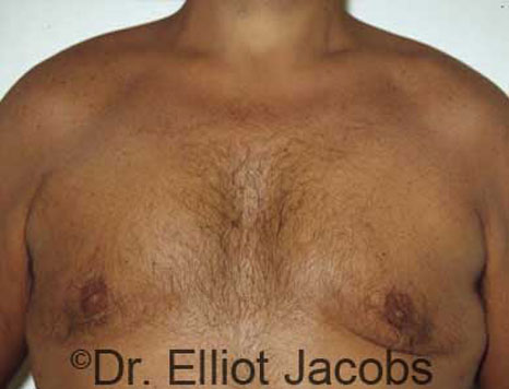 Male breast, after Gynecomastia treatment, front view, patient 17