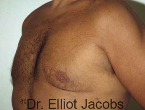 Male breast, after Gynecomastia treatment, l-side oblique view - patient 17