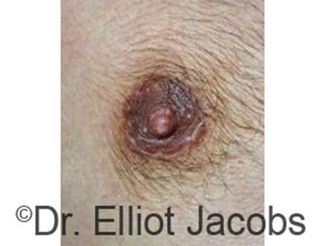 Male nipple, after Peri-Areolar Scars treatment, front view, patient 17