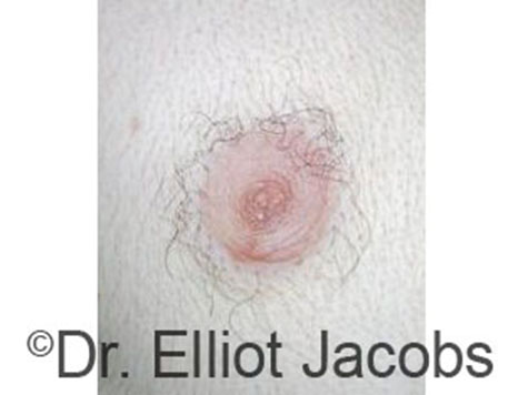 Male nipple, after Peri-Areolar Scars treatment, front view - patient 19