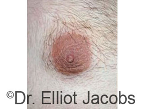 Male nipple, after Peri-Areolar Scars treatment, front view - patient 20