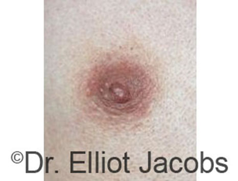 Male nipple, after Peri-Areolar Scars treatment, front view - patient 22