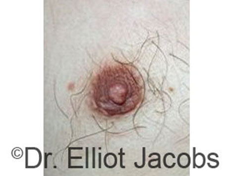 Male nipple, after Peri-Areolar Scars treatment, front view, patient 23