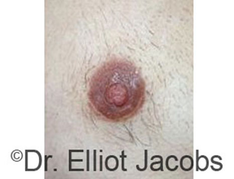 Male nipple, after Peri-Areolar Scars treatment, front view - patient 24