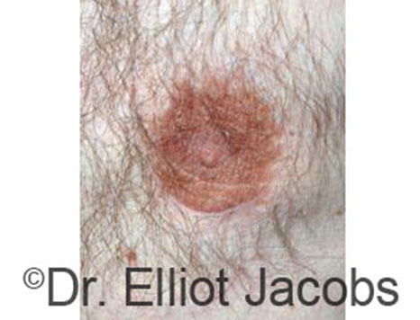 Male nipple, after Peri-Areolar Scars treatment, front view, patient 25