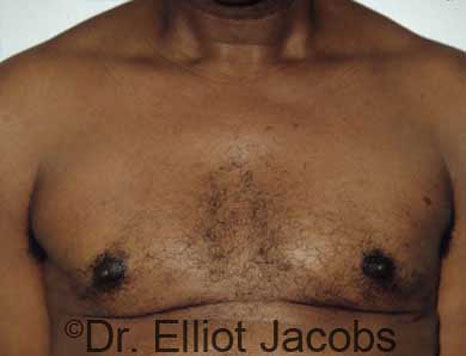 Male breast, after Gynecomastia treatment, front view, patient 18
