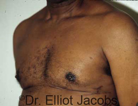 Male breast, after Gynecomastia treatment, l-side oblique view - patient 18