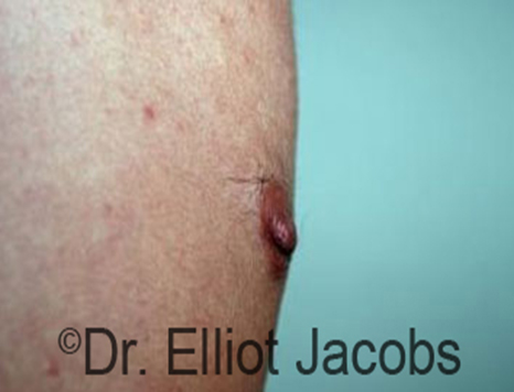 Male nipple, after Puffy Nipple treatment, r-side view - patient 3