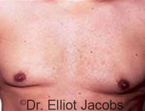 Male breast, after Gynecomastia treatment, front view, patient 19
