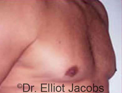 Male breast, after Gynecomastia treatment, r-side oblique view - patient 19