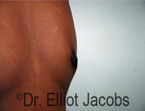 Male nipple, after Puffy Nipple Reduction treatment, oblique view, patient 2