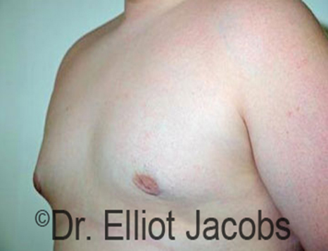Male breast, after Puffy Nipple Reduction treatment, oblique view, patient 1