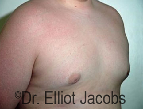 Male nipple, after Puffy Nipple treatment, r-side oblique view - patient 15