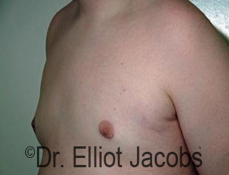 Male nipple, after Puffy Nipple treatment, l-side oblique view - patient 16