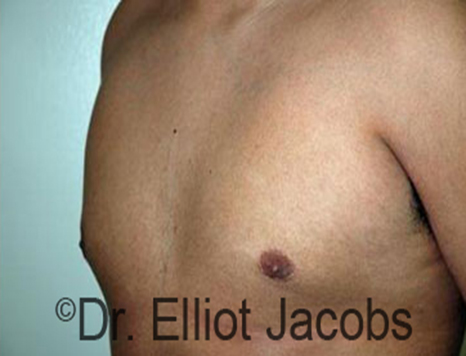 Male nipple, after Puffy Nipple treatment, l-side oblique view - patient 17