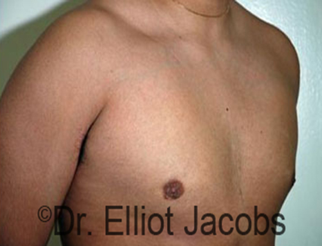 Male nipple, after Puffy Nipple treatment, r-side oblique view - patient 17