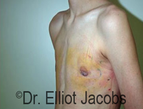 Male nipple, after Puffy Nipple treatment, l-side oblique view - patient 18