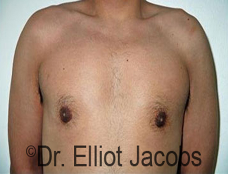 Male nipple, after Puffy Nipple treatment, front view - patient 20