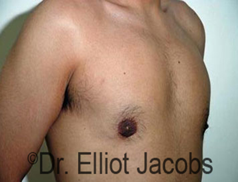 Male nipple, after Puffy Nipple treatment, r-side oblique view - patient 20