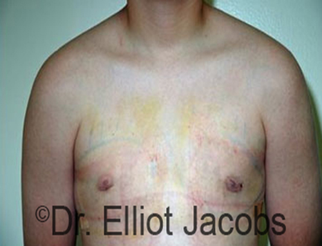 Male nipple, after Puffy Nipple treatment, front view - patient 21