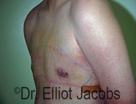 Male nipple, after Puffy Nipple treatment, l-side oblique view - patient 21