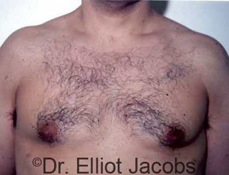 Male breast, after Gynecomastia treatment, front view, patient 2