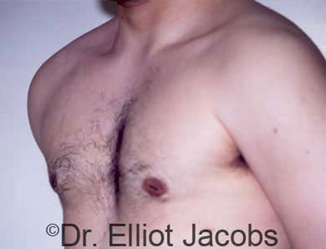 Male breast, after Gynecomastia treatment, l-side oblique view - patient 20