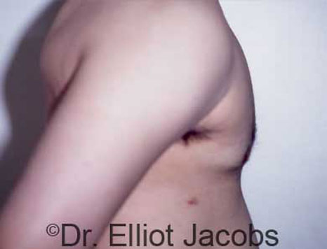 Male breast, after Gynecomastia treatment, r-side view - patient 20
