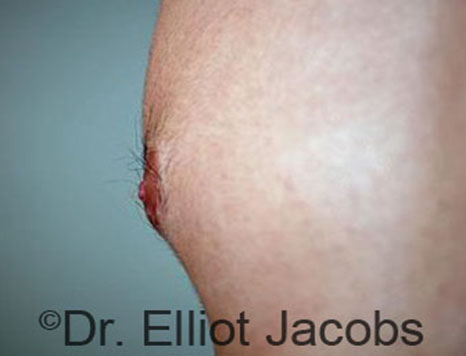 Male nipple, after Puffy Nipple treatment, l-side oblique view - patient 24