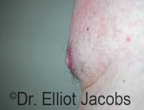 Male nipple, after Puffy Nipple treatment, side view - patient 39
