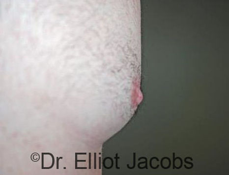 Male nipple, after Puffy Nipple treatment, oblique view - patient 41