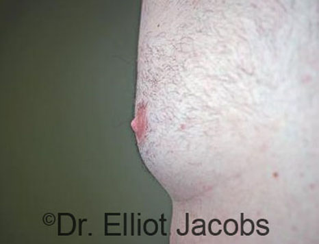 Male nipple, after Puffy Nipple treatment, side view - patient 41